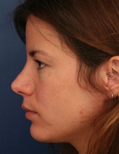 After Image: Rhinoplasty - left-side