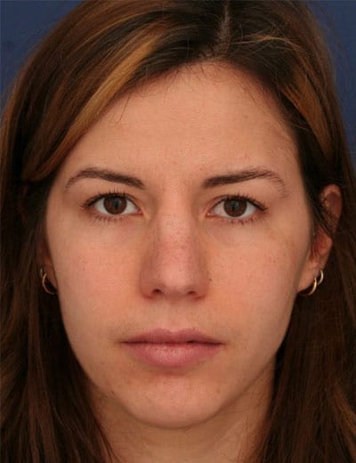 Before Image: Rhinoplasty - front