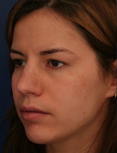 Before Image: Rhinoplasty - left-front-oblique