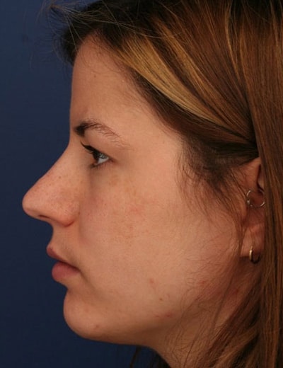Before Image: Rhinoplasty - left-side