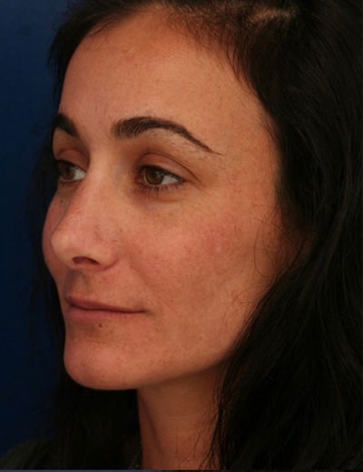 After Image: Rhinoplasty - left-front-oblique