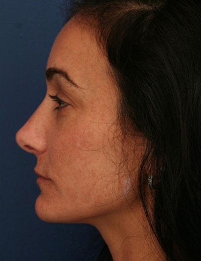 After Image: Rhinoplasty - left-side