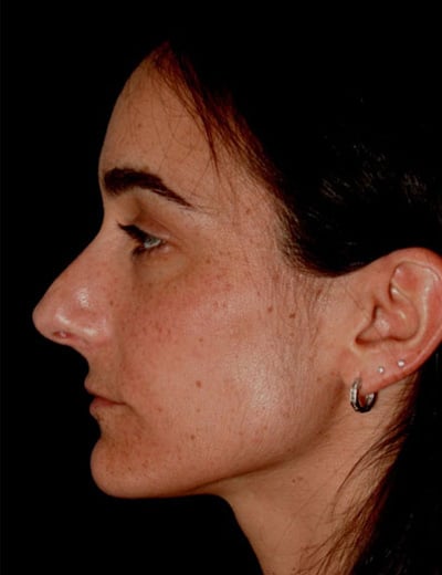 Before Image: Rhinoplasty - left-side
