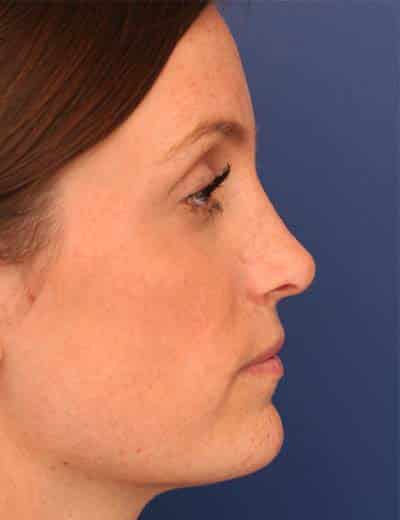 After Image: Rhinoplasty - right-side