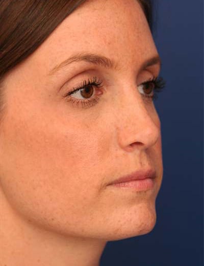After Image: Rhinoplasty - right-front-oblique