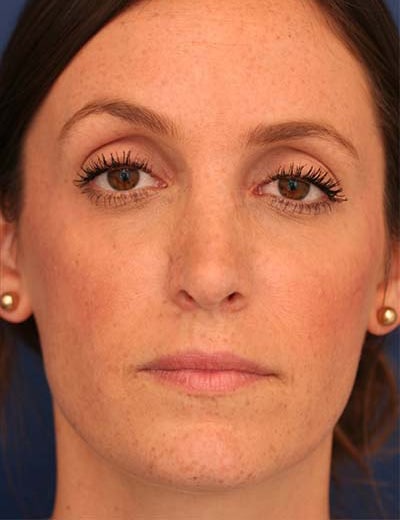 After Image: Rhinoplasty - front