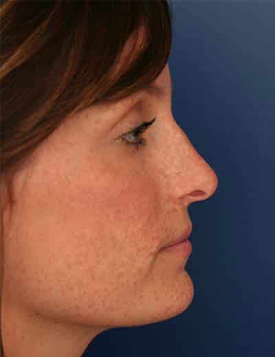 Before Image: Rhinoplasty - right-side
