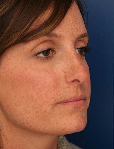 Before Image: Rhinoplasty - right-front-oblique