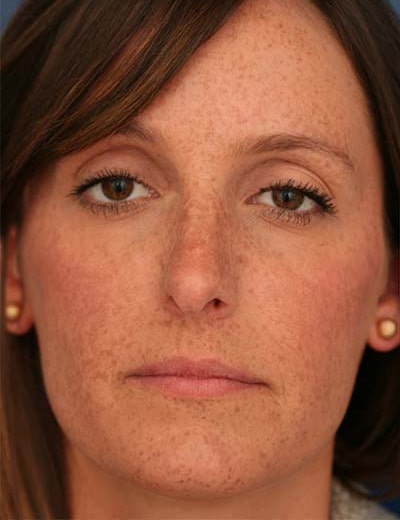 Before Image: Rhinoplasty - front
