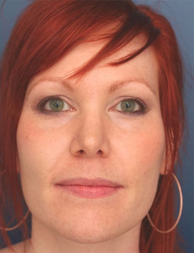After Image: Rhinoplasty - front
