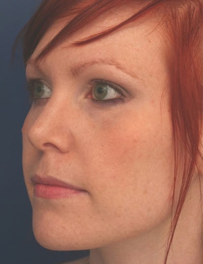 After Image: Rhinoplasty - left-front-oblique