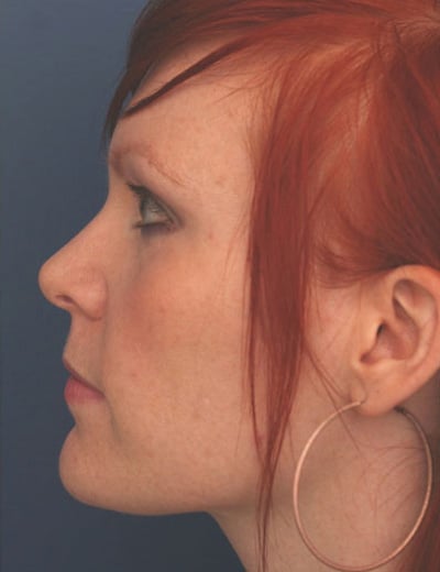 After Image: Rhinoplasty - left-side