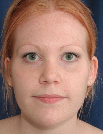 Before Image: Rhinoplasty - front