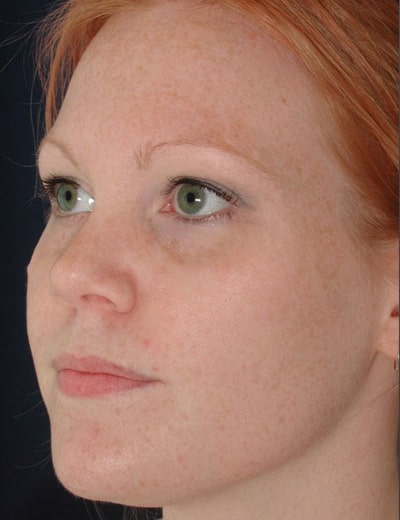 Before Image: Rhinoplasty - left-front-oblique