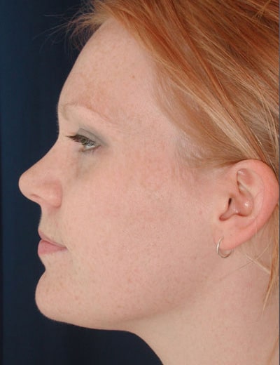 Before Image: Rhinoplasty - left-side