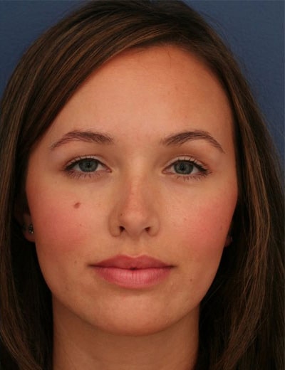 After Image: Rhinoplasty - front