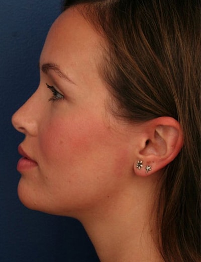 After Image: Rhinoplasty - left-side
