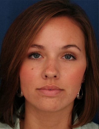 Before Image: Rhinoplasty - front