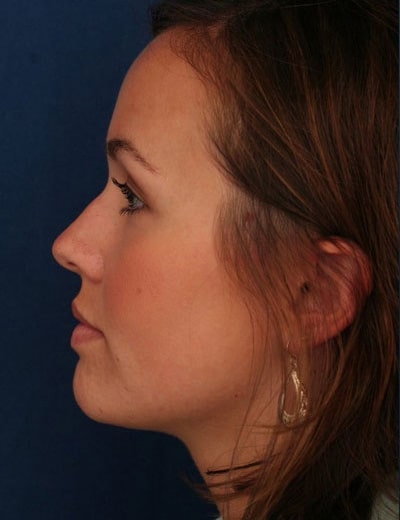 Before Image: Rhinoplasty - left-side