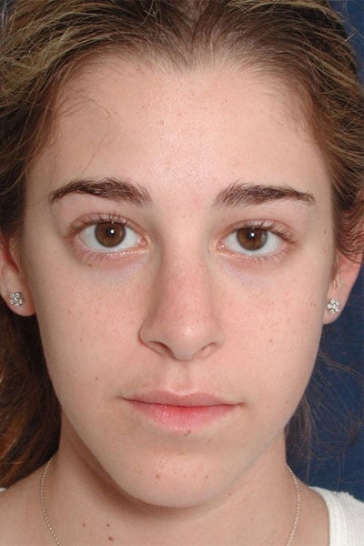 After Image: Rhinoplasty - front