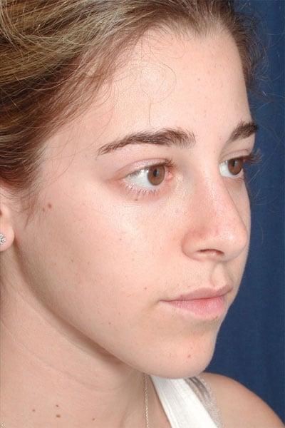 After Image: Rhinoplasty - right-front-oblique