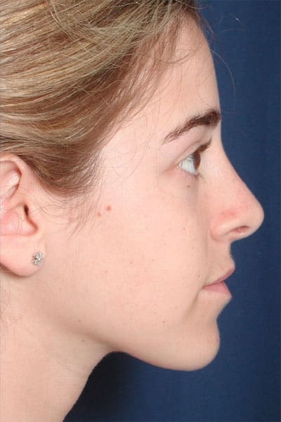 After Image: Rhinoplasty - right-side