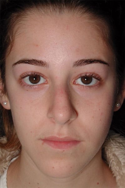 Before Image: Rhinoplasty - front