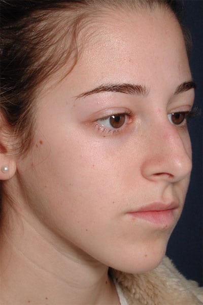 Before Image: Rhinoplasty - right-front-oblique