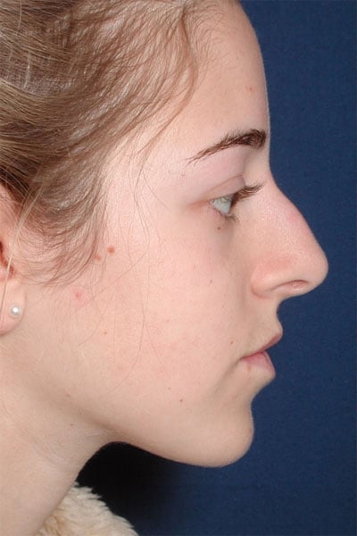 Before Image: Rhinoplasty - right-side