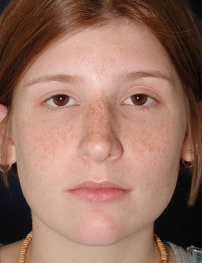 After Image: Rhinoplasty - front