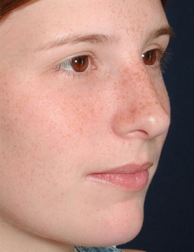 After Image: Rhinoplasty - right-front-oblique