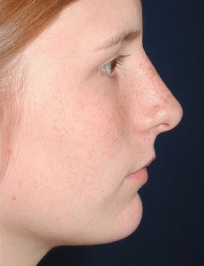 After Image: Rhinoplasty - right-side