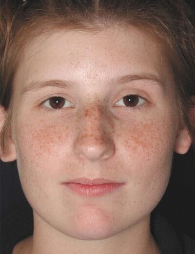 Before Image: Rhinoplasty - front
