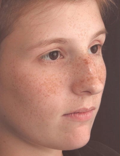 Before Image: Rhinoplasty - right-front-oblique