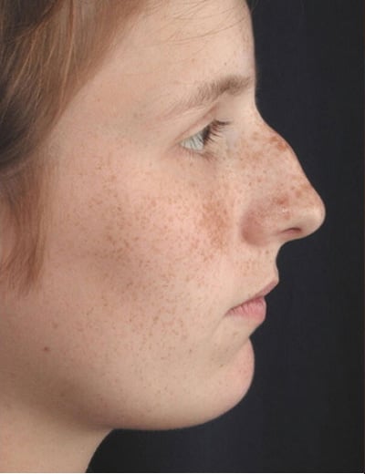 Before Image: Rhinoplasty - right-side