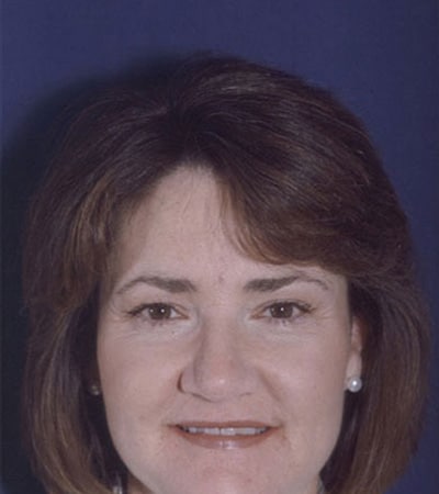 After Image: Rhinoplasty - front