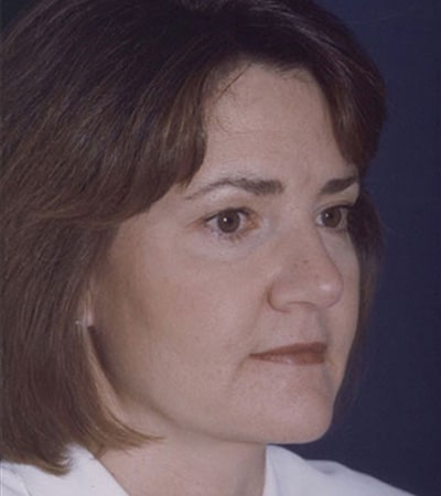 After Image: Rhinoplasty - right-front-oblique