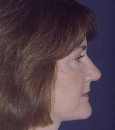 After Image: Rhinoplasty - right-side