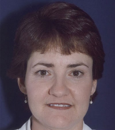 Before Image: Rhinoplasty - front