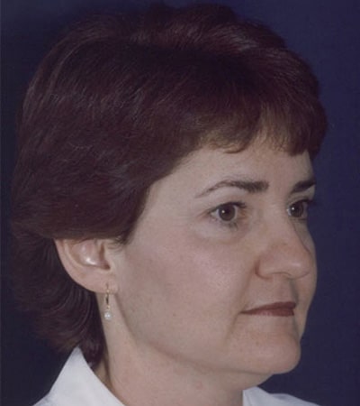 Before Image: Rhinoplasty - right-front-oblique