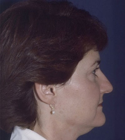 Before Image: Rhinoplasty - right-side