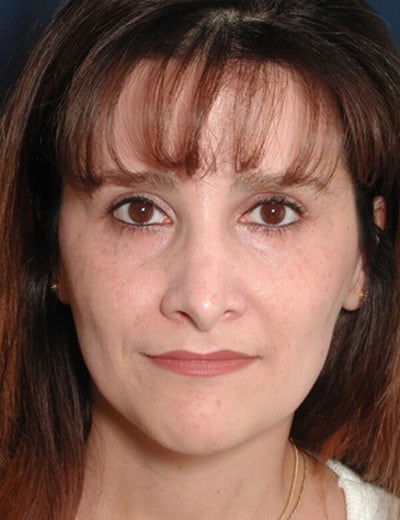 After Image: Rhinoplasty - front