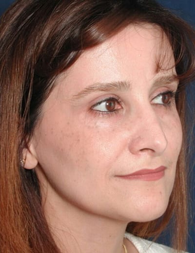 After Image: Rhinoplasty - right-front-oblique