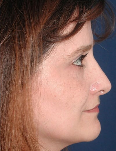 After Image: Rhinoplasty - right-side