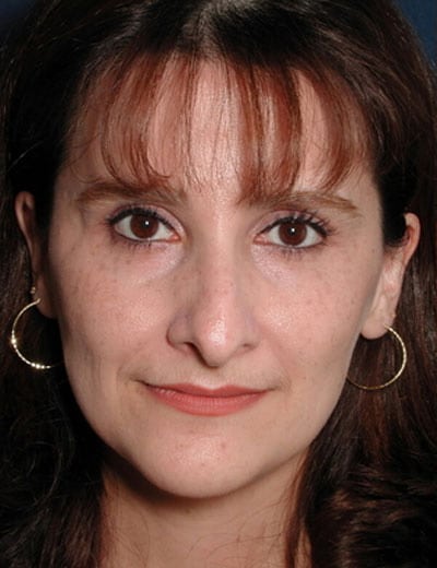 Before Image: Rhinoplasty - front