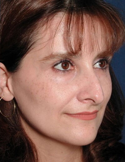 Before Image: Rhinoplasty - right-front-oblique