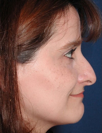 Before Image: Rhinoplasty - right-side
