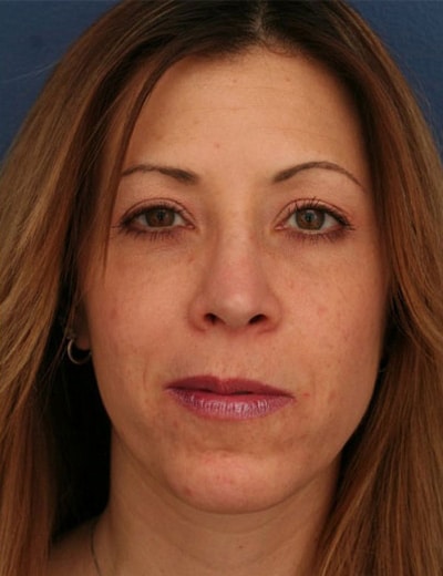 After Image: Rhinoplasty - front