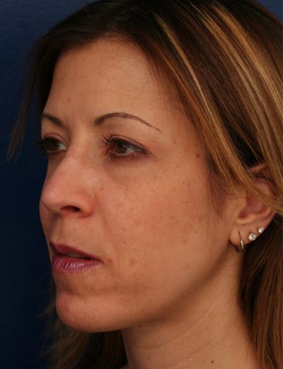 After Image: Rhinoplasty - left-front-oblique