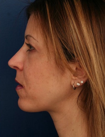 After Image: Rhinoplasty - left-side